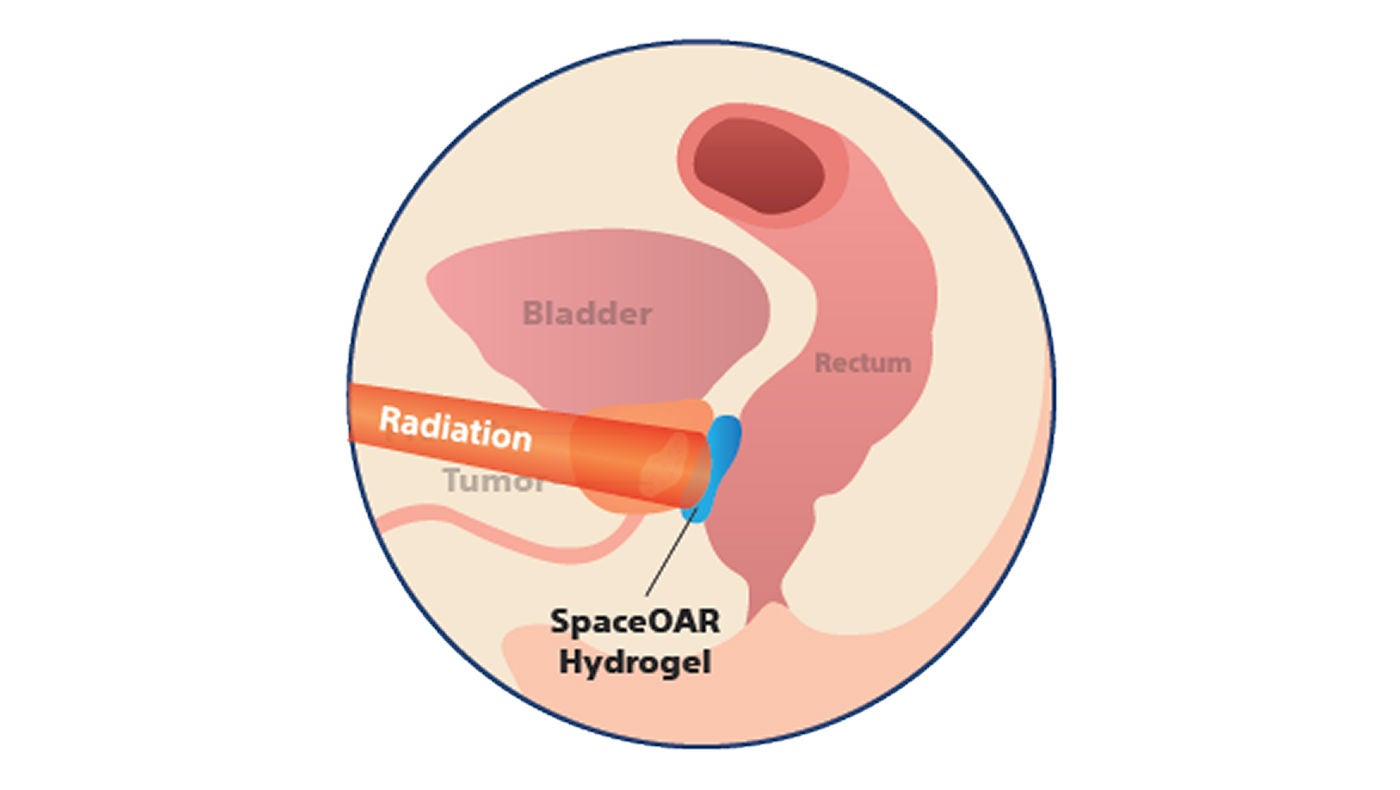 Illustration av prostata under strålbehandling med hydrogelspacer.