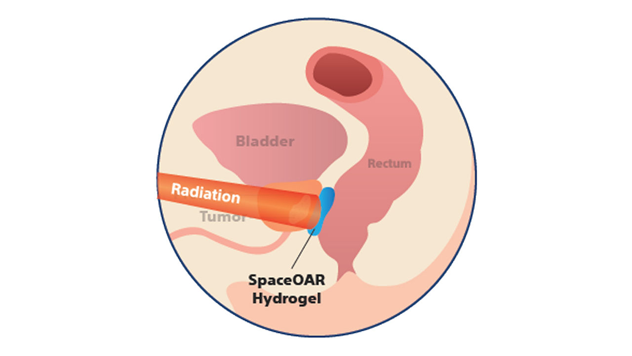 Illustration av prostata under strålbehandling med hydrogelspacer.