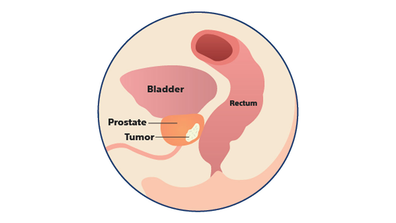 Illustration of anatomy of a prostate without hydrogel spacer