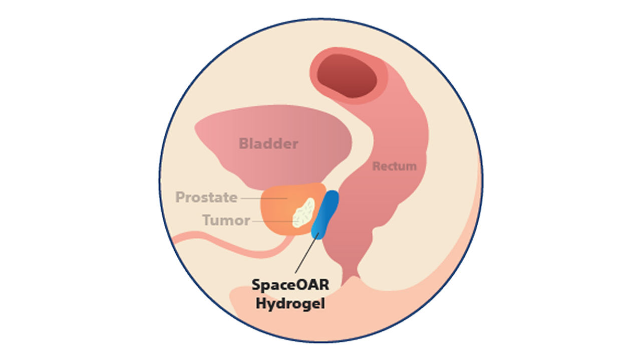 Illustration of anatomy of a prostate protected by hydrogel spacer